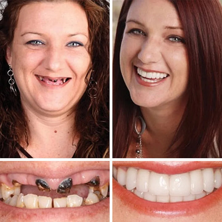 Ends Today: 70% OFF! ⏰HazyGalaxy™  Medical Full Denture with Strong Suctiond Custom-Fit Full Functional Dentures🦷