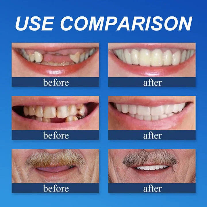 Ends Today: 70% OFF! ⏰HazyGalaxy™  Medical Full Denture with Strong Suctiond Custom-Fit Full Functional Dentures🦷