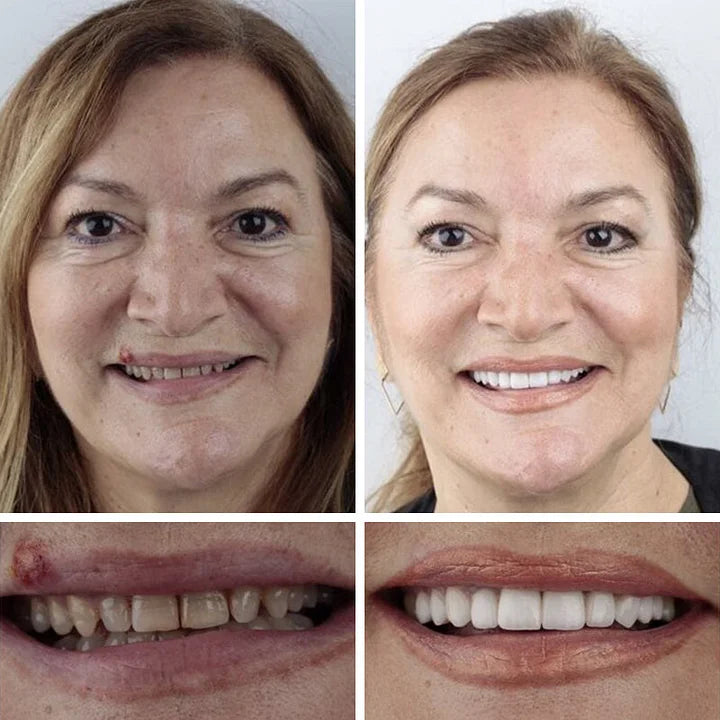 Ends Today: 70% OFF! ⏰HazyGalaxy™  Medical Full Denture with Strong Suctiond Custom-Fit Full Functional Dentures🦷