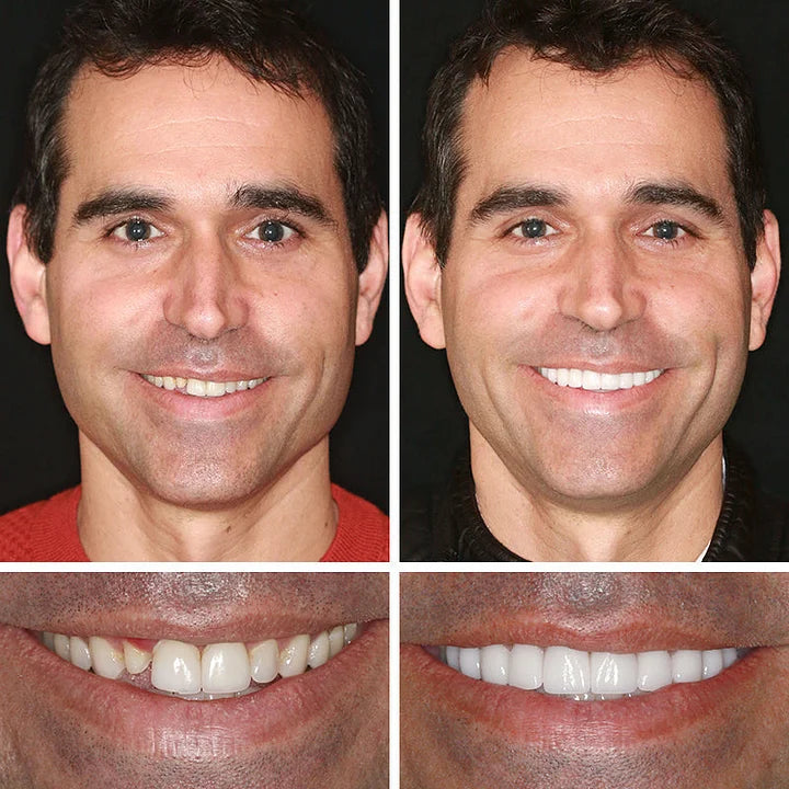 Ends Today: 70% OFF! ⏰HazyGalaxy™  Medical Full Denture with Strong Suctiond Custom-Fit Full Functional Dentures🦷