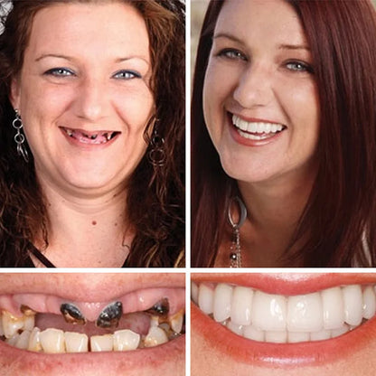 --Ends Today: 75% OFF! ⏰DarkFairy™ Medical Full Denture with Strong Suctiond Custom-Fit Full Functional Dentures🦷
