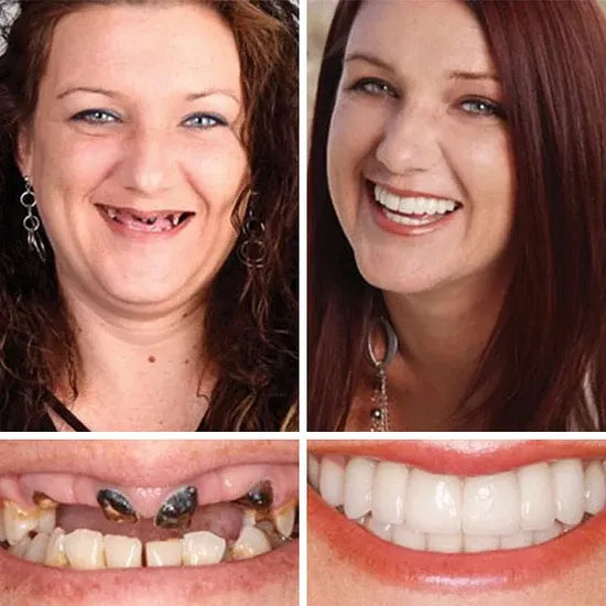 2🔥HazyGalaxy™ Soft Silicone Carbon Ceramic Teeth, Strong and White – Natural Look, Comfortable Fit