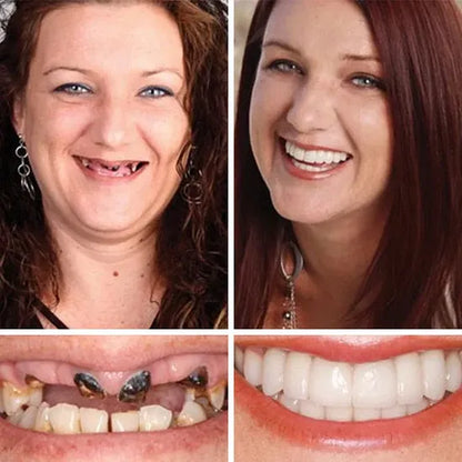 2🔥HazyGalaxy™ Soft Silicone Carbon Ceramic Teeth, Strong and White – Natural Look, Comfortable Fit