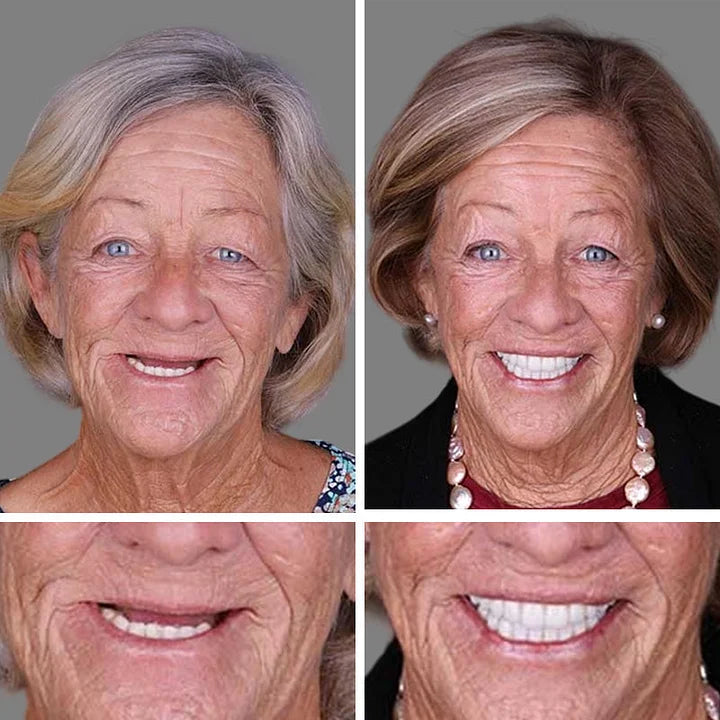 Ends Today: 70% OFF! ⏰HazyGalaxy™  Medical Full Denture with Strong Suctiond Custom-Fit Full Functional Dentures🦷